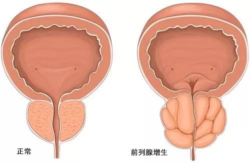 前列腺增生，尿頻、尿急怎么辦？等離子電切術(shù)治愈！